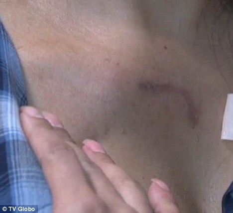 Click to enlarge borken collar bone