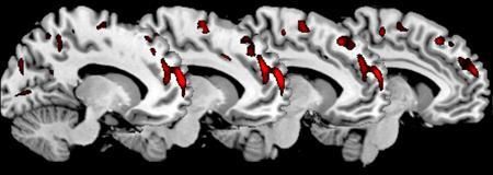 psychopaths brains 1