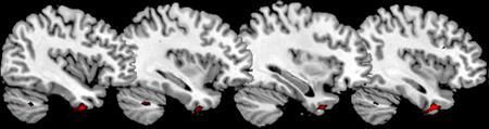 psychopaths brains 2
