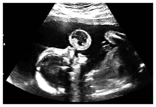 Unborn Fetus