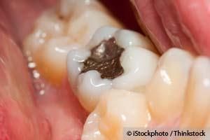 amalgam