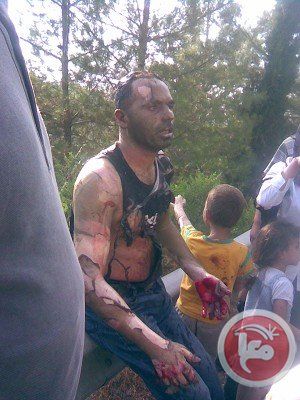 injured Palestinian Israeli firebomb
