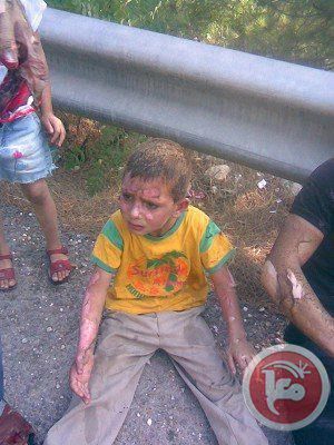 Palestinian child injured by molotov