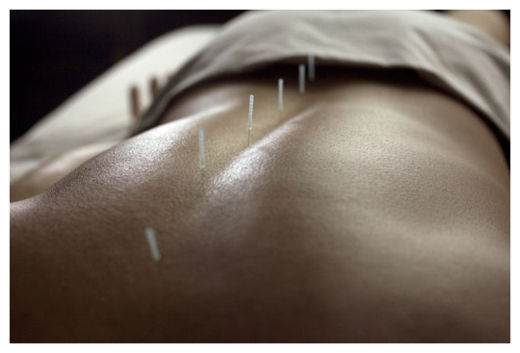 Acupuncture