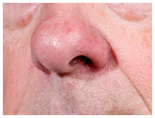Nose
