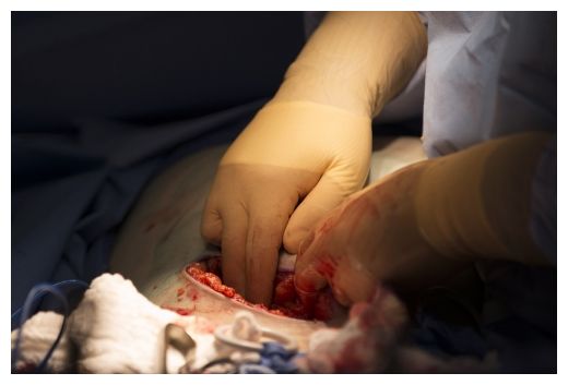 Organ Harvest