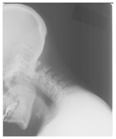Internal decapitation