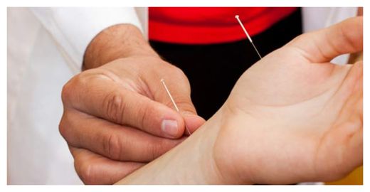 Acupunture