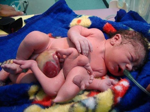 Click to enlarge Fallujah Birth Defect