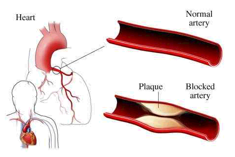 Chelation Therapy