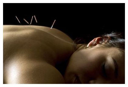 Acupuncture