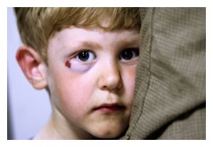 Childhood Trauma