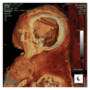 Click to enlarge Brain Removal Tool
