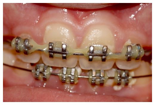 Brace