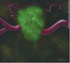 Click to enlarge cancer fungi2
