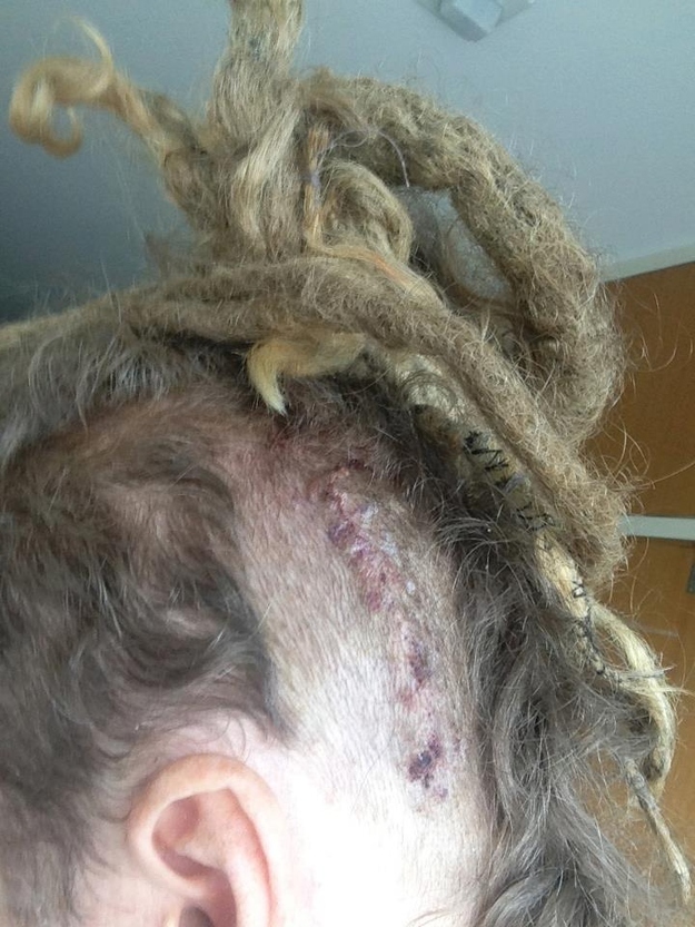 Brain Surgery