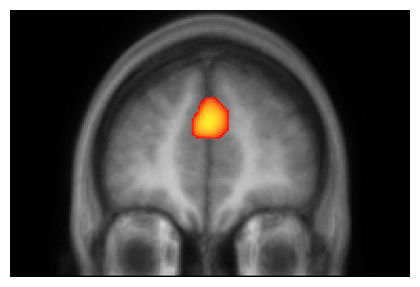 fMRI Scan