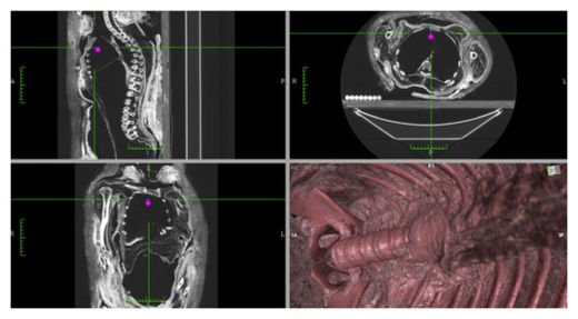 Click to enlarge CT Scan of Mummy
