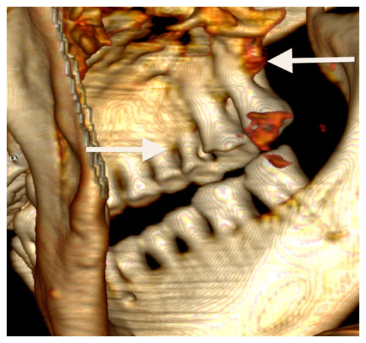 Otzi's Teeth_1