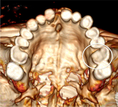 Otzi's Teeth_2