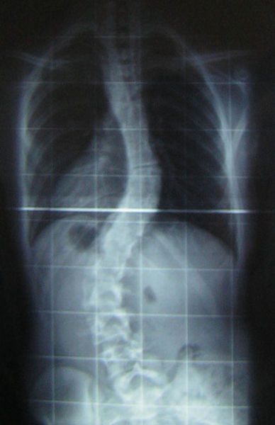 Click to enlarge Scoliosis
