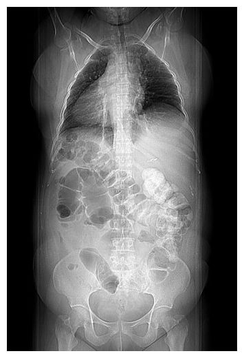 Click to enlarge Situs inversus