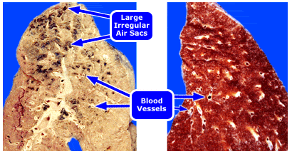 tar lung