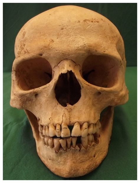 Click to enlarge Skull with Leprosy