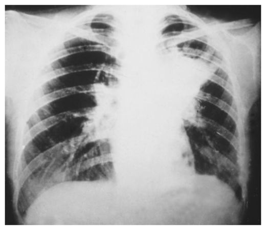 Lung Infection