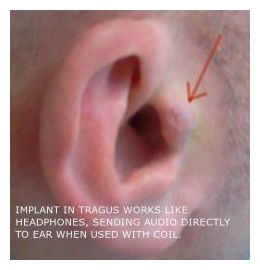 Implant_1