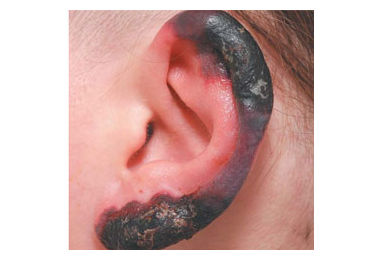 Frostbite?