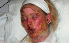 Drug companies failed to warn patients that toxic epidermal necrolysis 