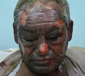 White phosphorus 10