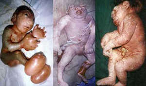 Fallujah Aborted Fetuses
