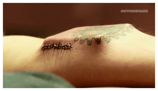 Implant