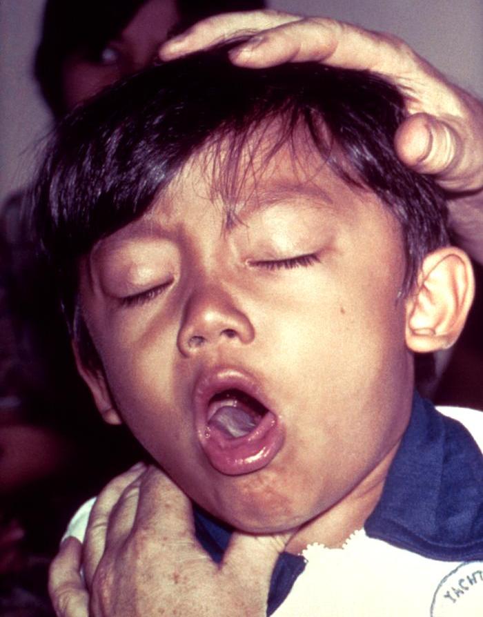 Click to enlarge whooping cough boy