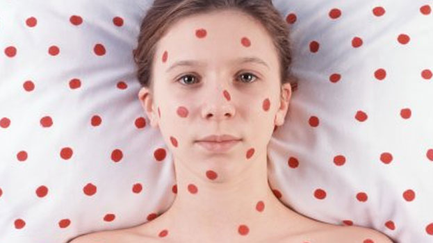 Measles