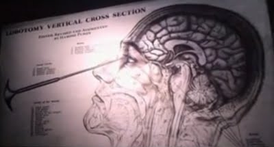 Click to enlarge Lobotomy