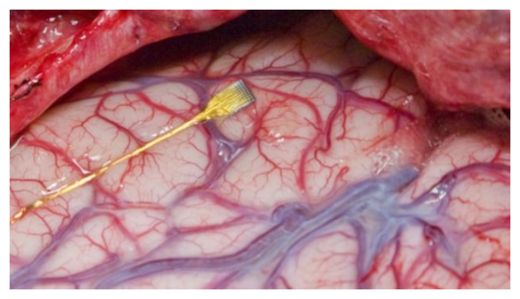 Click to enlarge Implant_1
