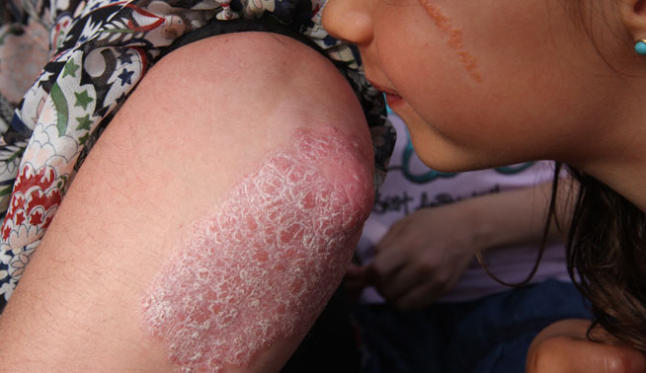 psoriasis