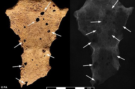 cancer in ancient skeleton