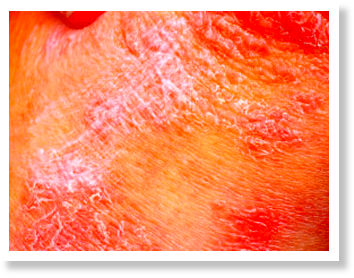 Rash