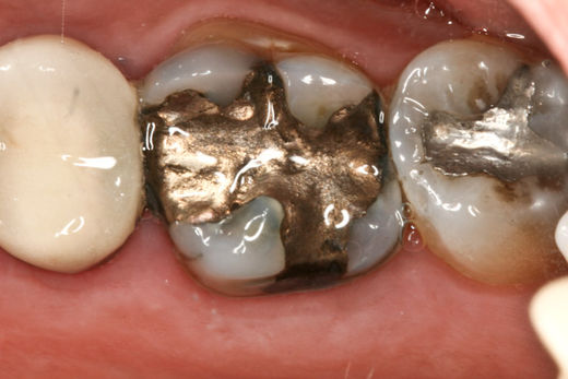 dental fillings