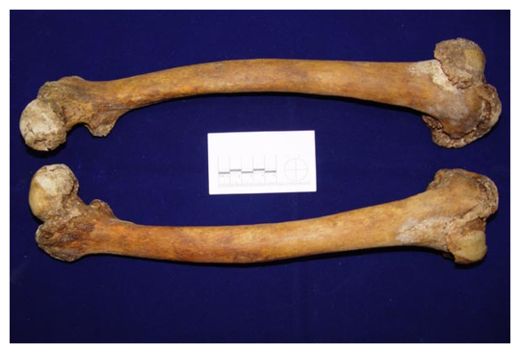 Femur Bones
