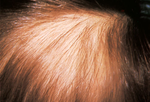 Trichotillomania