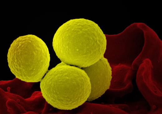 superbug