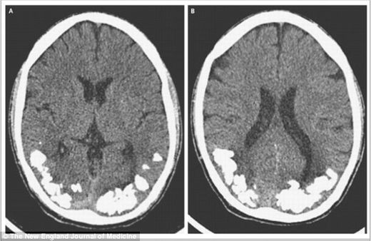 gluten calcium brain