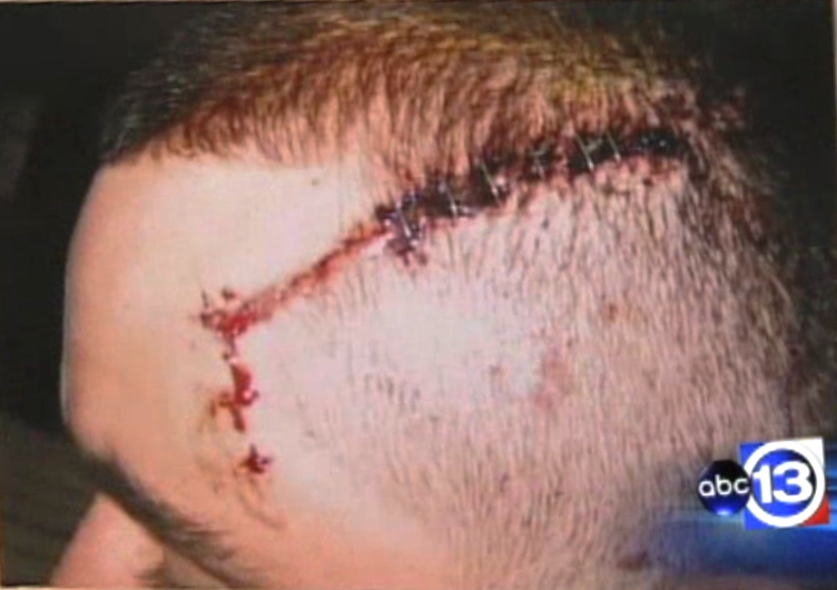 Cole O’Balle’s head wound