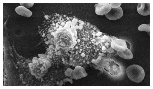 Cancer Cells
