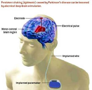 Electronic brain stimulator
